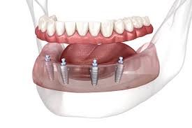 All-on-4 y All-on-6 — dientes fijos sobre implantes