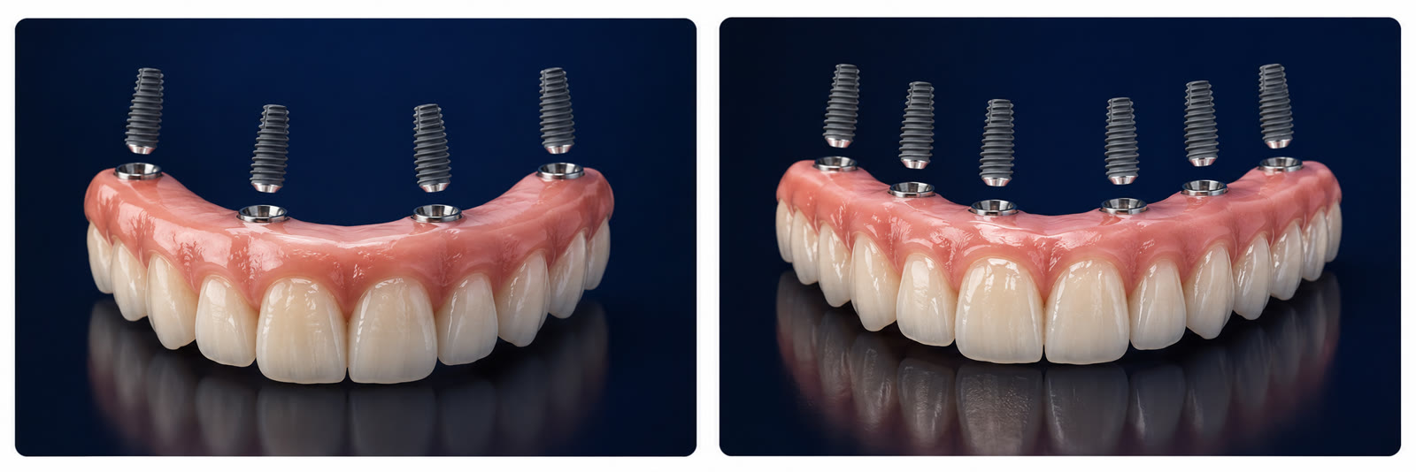 All-on-4 y All-on-6 — dientes fijos sobre implantes